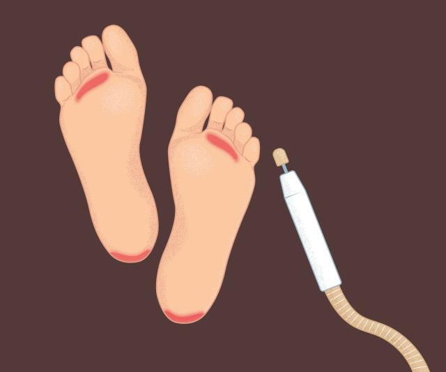 Фото Подологическая обработка стоп