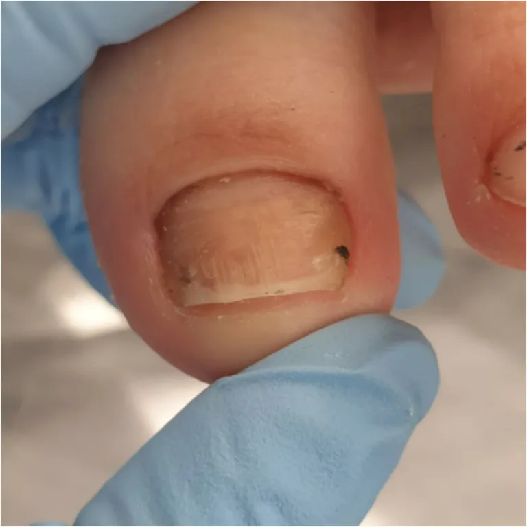 Фото примера лечения ногтевой пластины 2