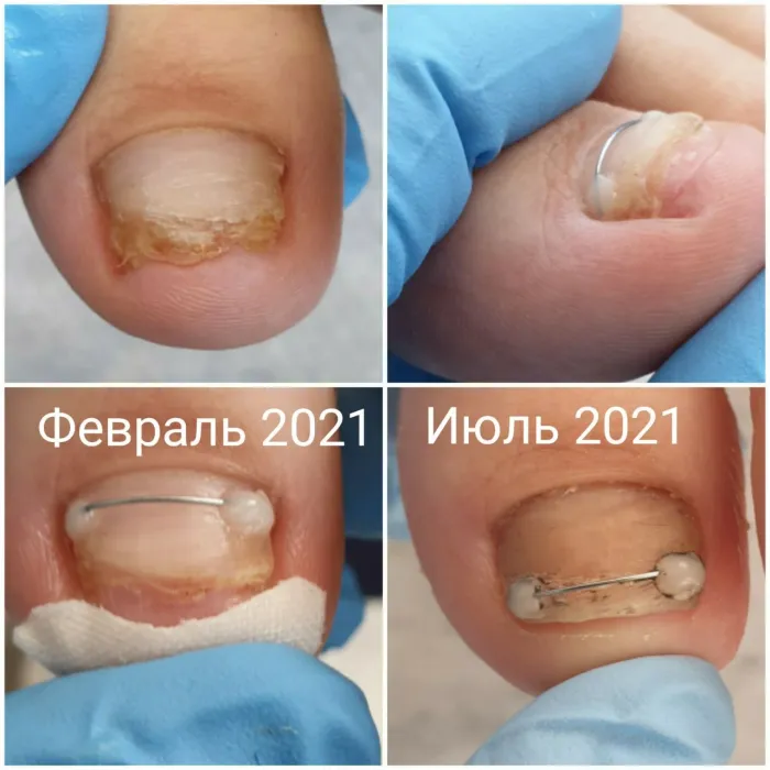 Пример лечение деформации ногтевой пластины​